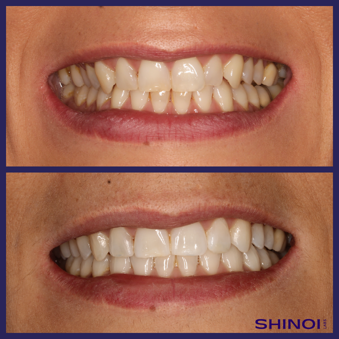 Blanqueamiento dental con fundas, ¿es posible?