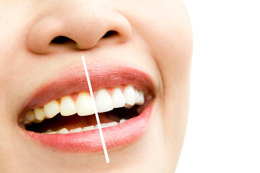 Tipos de blanqueamiento dental y cómo funcionan