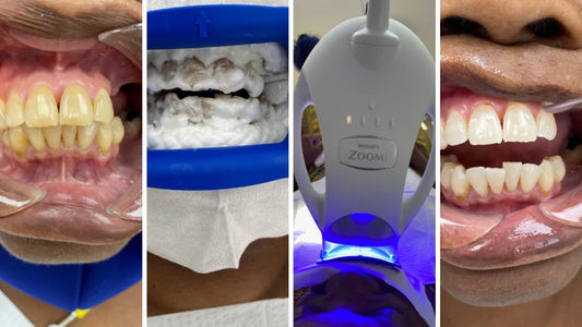 Blanqueamiento dental Philips Zoom, ¿merece la pena?