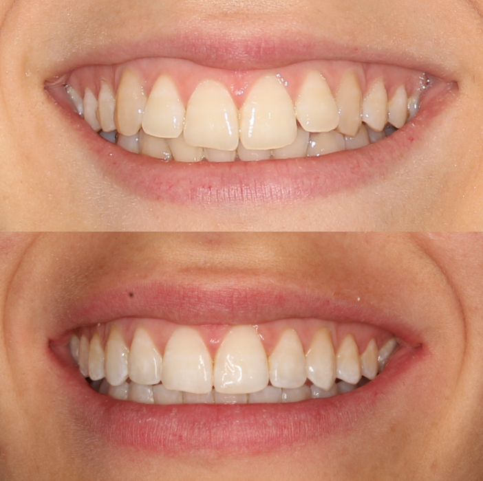 Blanqueamiento dental antes y después