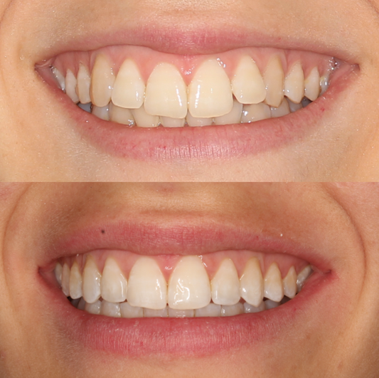 Blanqueamiento dental antes y después