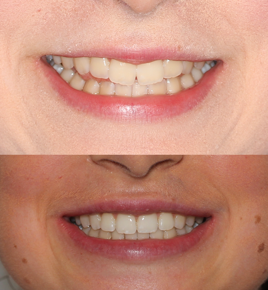 El mejor blanqueador dental en España es SHINOI