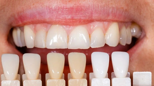 Blanqueamiento dental: pros y contras