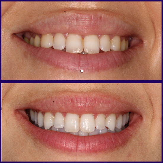 Kit blanqueamiento universal